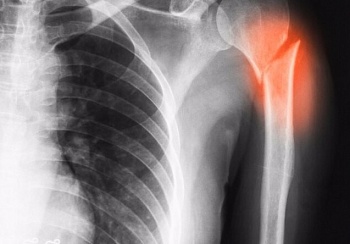 Разлагающиеся костные имплантаты: будущее трансплантологии