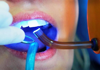 Современная стоматология и полимеры